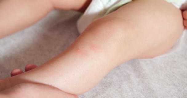 Mamma sta strofinando l'unguento per l'acne del bambino sulla gamba dei ragazzini — Video Stock