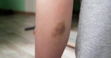 Ellerin bacağa merhem sürmesi. Diz yaralanması, deri hematomu, cilt onarımı konsepti. yavaş çekim