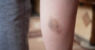 Ellerin bacağa merhem sürmesi. Diz yaralanması, deri hematomu, cilt onarımı konsepti. yavaş çekim