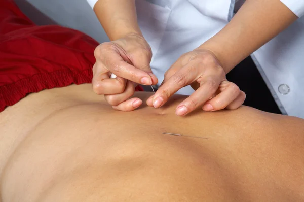 Acupuncture of back — Stock Photo, Image