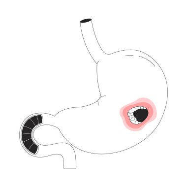 Peptik ülser çizgili insan midesi. Anatomik organ iltihabı. Sindirim hastalığı. Gastrobağırsak yolu yarası 2D çizgi nesnesi beyaza izole edildi. Tek renkli vektör doğrusal resmi