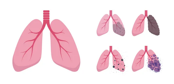 Набір ілюстрацій легень. Здорові та хворі легені. Піктограми дихальної системи людини — стоковий вектор