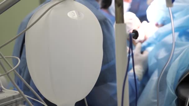 Анестезія під час операції крупним планом вентилятора під час операції . — стокове відео