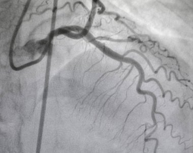 Coronary angiography , Left coronary artery disease. clipart