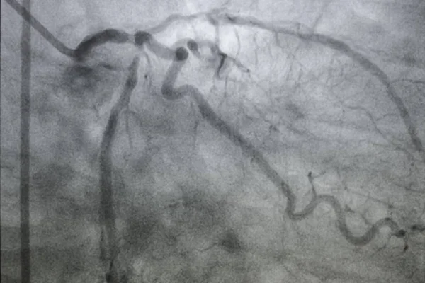冠状动脉造影 左冠状动脉疾病 — 图库照片