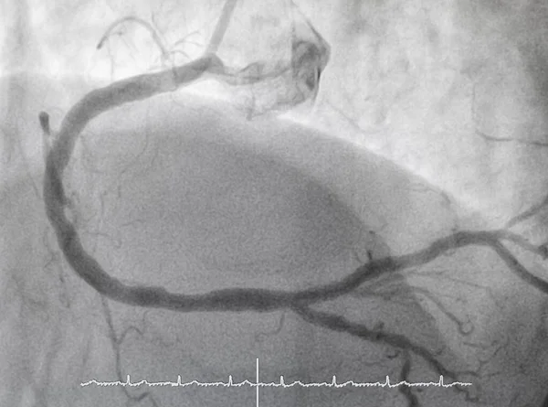 Angiografía Coronaria Enfermedad Arterial Coronaria Derecha — Foto de Stock