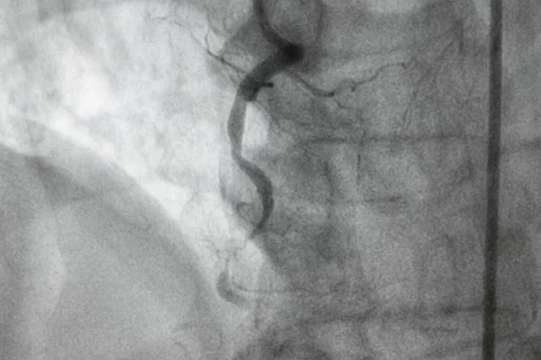 Коронарна Ангіографія Хвороба Правої Коронарної Артерії — стокове фото