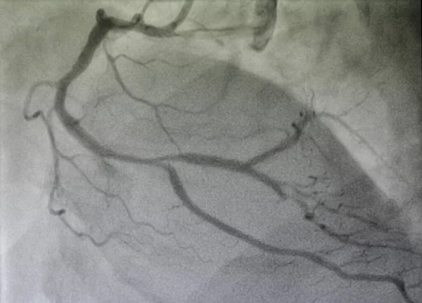 Koronarangiographie Rechte Koronare Herzkrankheit — Stockfoto