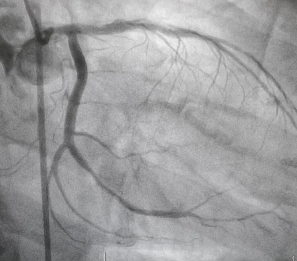Angiografi Koroner Meninggalkan Penyakit Arteri Koroner — Stok Foto