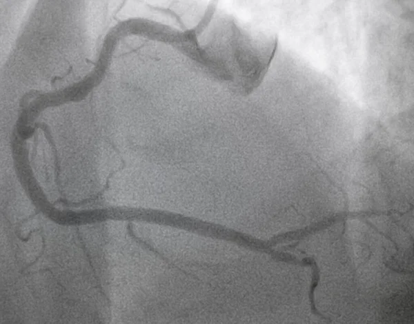 Angiografía Coronaria Enfermedad Arterial Coronaria Derecha — Foto de Stock