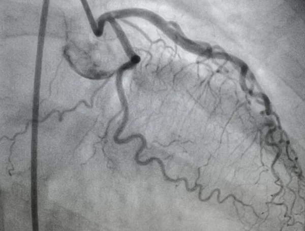 冠状动脉造影 左冠状动脉疾病 — 图库照片