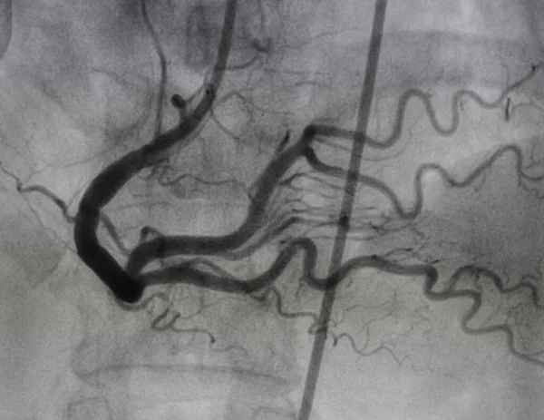 관상동맥 오른쪽 관상동맥 — 스톡 사진