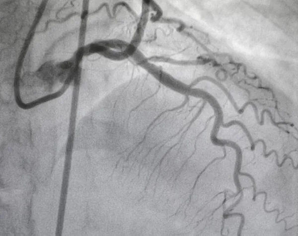 Coronaire Angiografie Linker Kransslagader Ziekte — Stockfoto