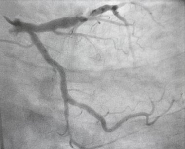 Koroner anjiyografi, sol koroner arter hastalığı..