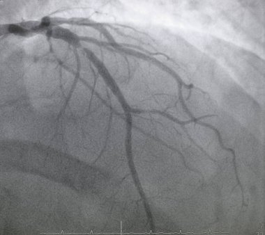 Koroner anjiyografi, sol koroner arter hastalığı..