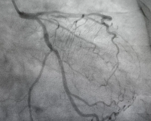Angiografia Coronariana Doença Arterial Coronariana Esquerda — Fotografia de Stock