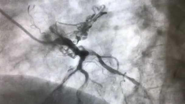 Angiograma Coronário Mostra Fístulas Artéria Coronária — Vídeo de Stock