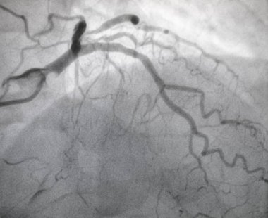 Koroner anjiyografi, sol koroner arter hastalığı..