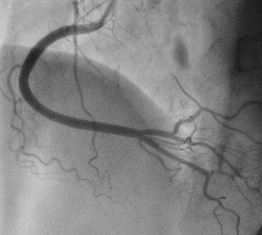 Koroner anjiyografi, normal sağ koroner arter..