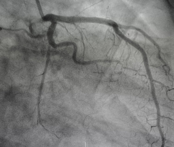 Коронарная ангиография, болезнь левой коронарной артерии.