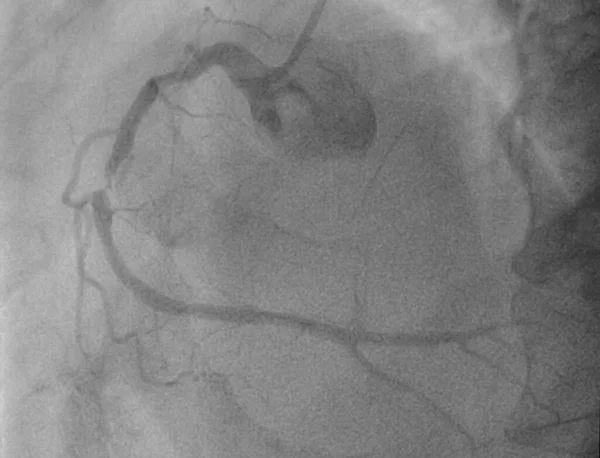 Angiografia Coronarica Normale Arteria Coronarica Destra — Foto Stock