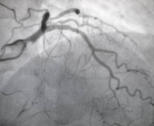 Коронарная ангиография, болезнь левой коронарной артерии.