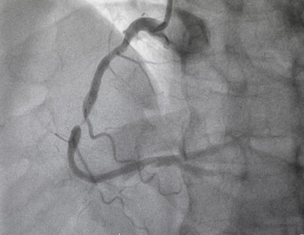 Coronary Angiography Normal Right Coronary Artery — Stock Photo, Image
