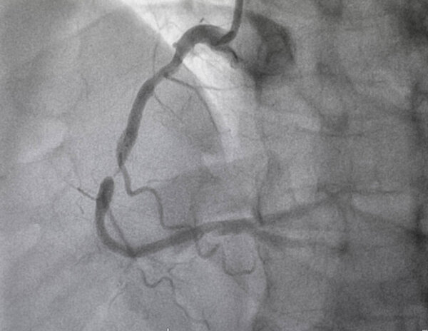 Coronary angiography , normal right coronary artery.