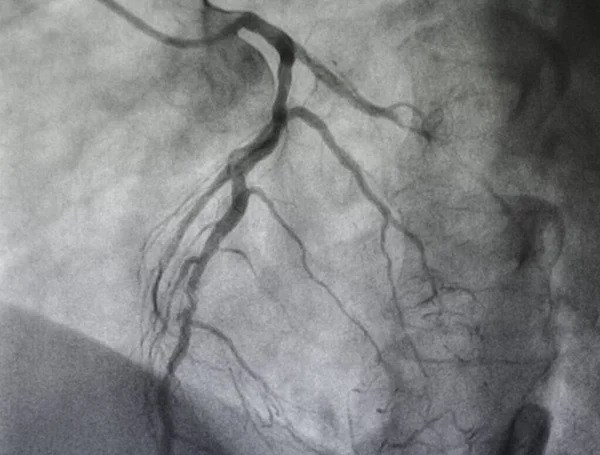Angiografía Coronaria Enfermedad Arterial Coronaria Izquierda — Foto de Stock