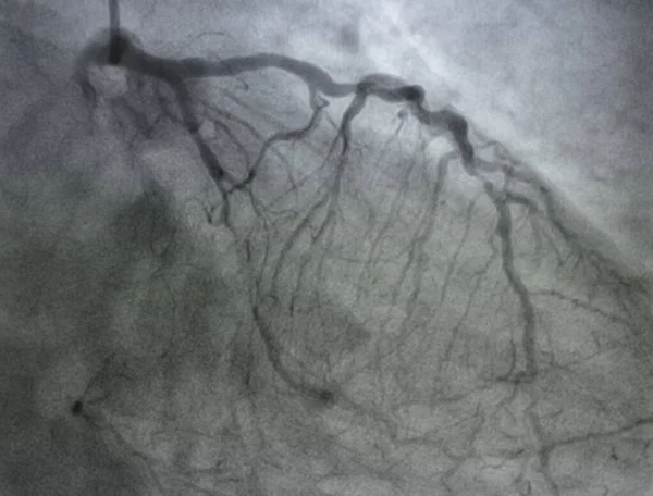 Angiografía Coronaria Enfermedad Arterial Coronaria Izquierda — Foto de Stock