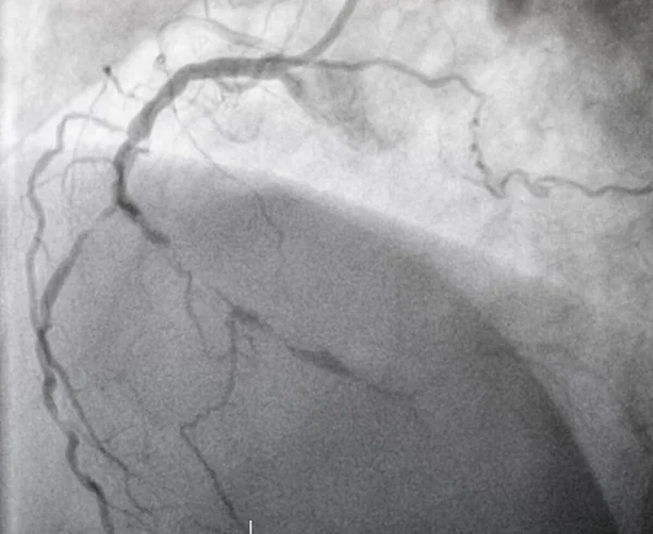 Koronarangiographie Normale Rechte Koronararterie — Stockfoto