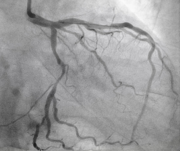 Коронарная ангиограмма, медицинский рентген сердечных заболеваний. Болезнь коронарных артерий.
