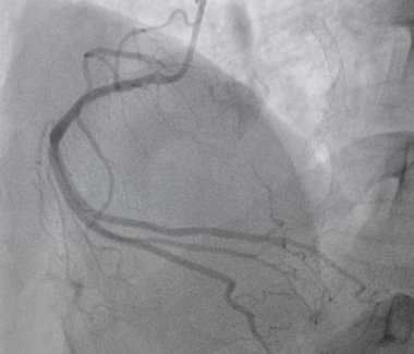 Koroner anjiyogram, kalp hastalığı için tıbbi röntgen. Koroner arter hastalığı..
