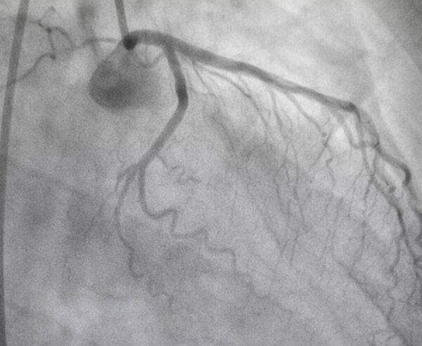 Коронарная ангиограмма, медицинский рентген сердечных заболеваний. Болезнь коронарных артерий.