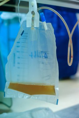 İdrar torbası tıbbi tedavi drenaj mesane lastik esnek vücut enfeksiyonu bakteri ölçümü tuvalet bacağı rahatlama kanser aleti kalkülüs vesik problem anatomi steril cerrahi üretra.