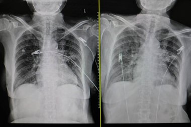 Tıbbi teşhis için insan göğsünün röntgen görüntüsü. X-ray göstergesi konjestif kalp yetmezliği.