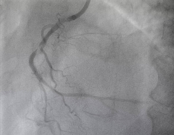 Коронарная ангиограмма, медицинский рентген сердца. Болезнь коронарных артерий.