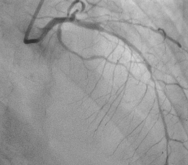 Коронарная ангиограмма, медицинский рентген сердца. Болезнь коронарных артерий.
