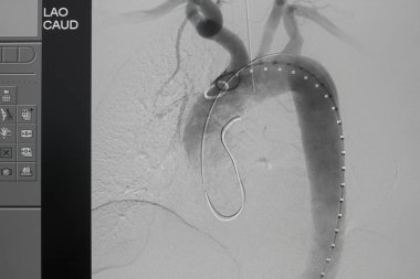 EVAR prosedürü sırasında infra renal abdominal aortik anevrizmada aort grefti uygulandıktan sonra anjiyogram sağ kalça atardamarı..