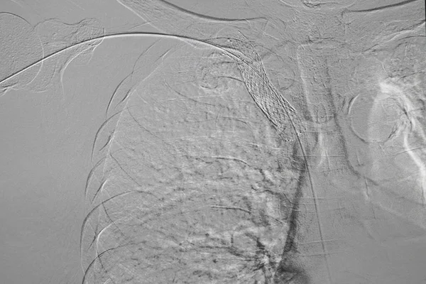 Ангиопластика Воздушная Ангиопластика Перкутанная Трансфутанная Ангиопластика Дпт Правой Руке — стоковое фото