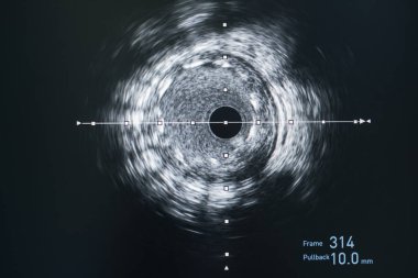 Kardiyak kateterizasyon laboratuvarında damar içi ultrason görüntüleme (IVUS).
