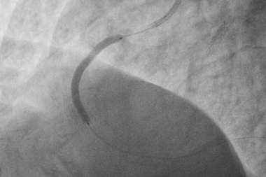 Coronary angiography , left and right coronary angiography clipart