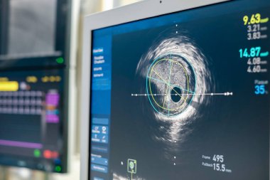 Intravascular ultrasound imaging (IVUS) at cardiac catheterization laboratory room. clipart