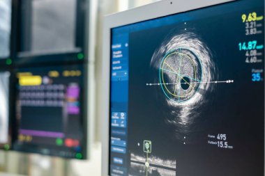 Intravascular ultrasound imaging (IVUS) at cardiac catheterization laboratory room. clipart