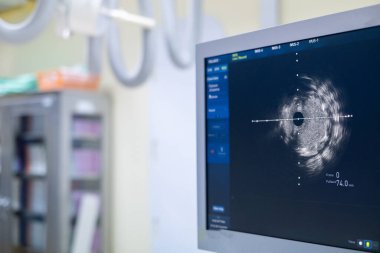 Kardiyak kateterizasyon laboratuvarında damar içi ultrason görüntüleme (IVUS).