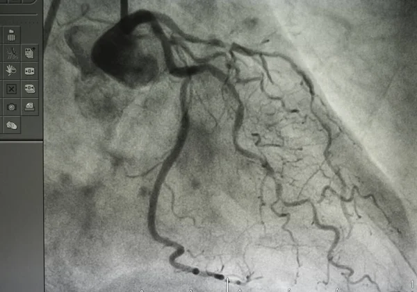 Coronary angiography , left and right coronary angiography