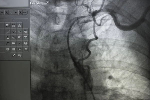 Coronary angiography , left and right coronary angiography