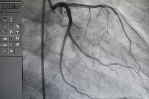 Coronary angiography , left and right coronary angiography