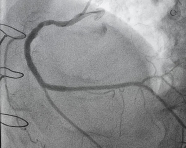 Koronar Angiografi Vänster Och Höger Koronar Angiografi — Stockfoto