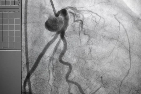 Coronary angiography , left and right coronary angiography